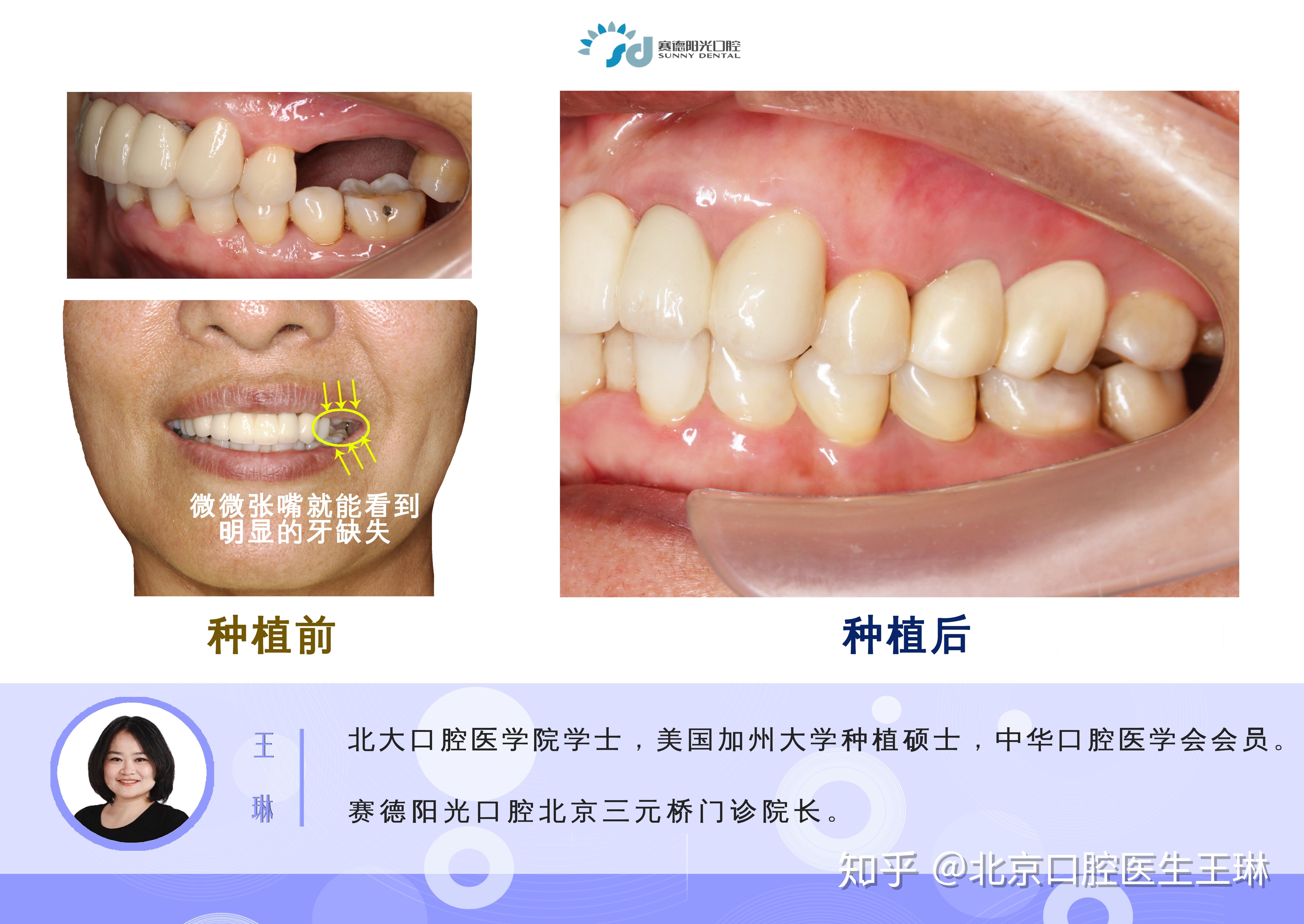 种植牙案例丨牙齿种植修复缺失的磨牙