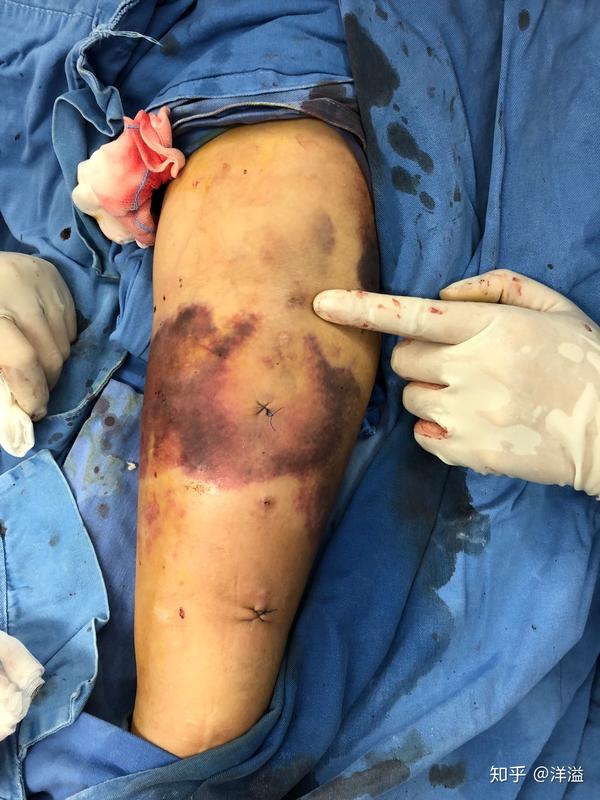 自体内瘘双鞘溶栓术钳夹术球囊扩张术