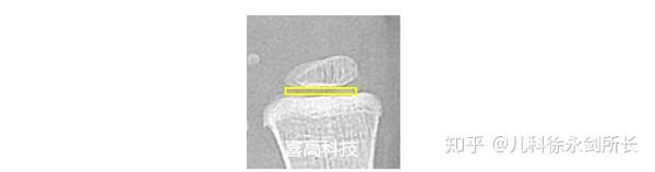 学习中华05标准骨龄鉴定的基础知识 - 知乎