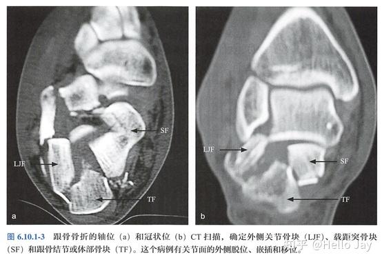 跟骨骨折的治疗原则 - 知乎
