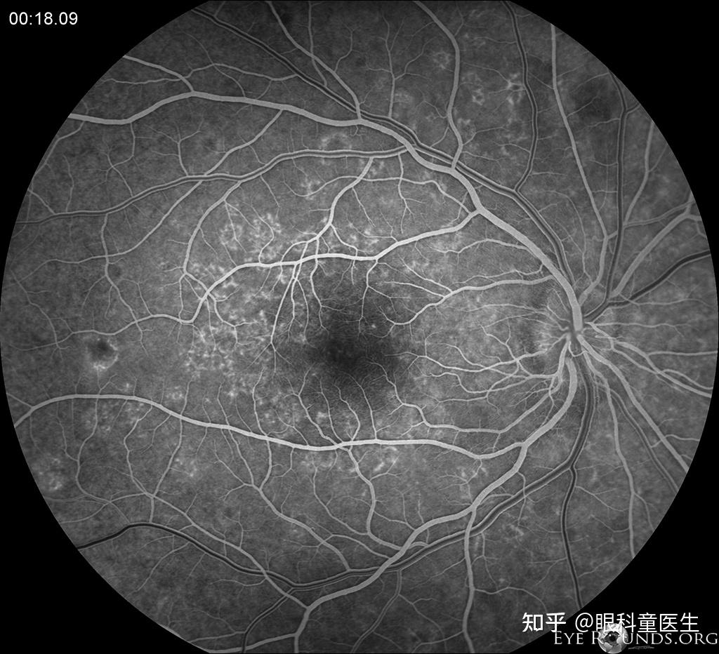 照片显示后极部视网膜多灶性的改变,在af上显示视盘周围的高自发荧光