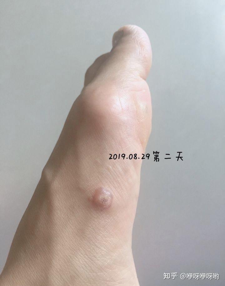 (多图慎入)终于鼓足勇气去治疗寻常疣!那是怎一个痛字…… - 知乎