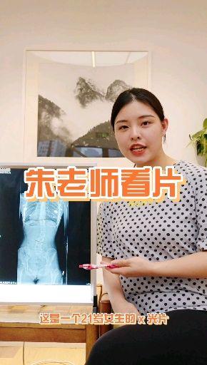 朱老师看片脊柱侧弯60度成年男性x光评估
