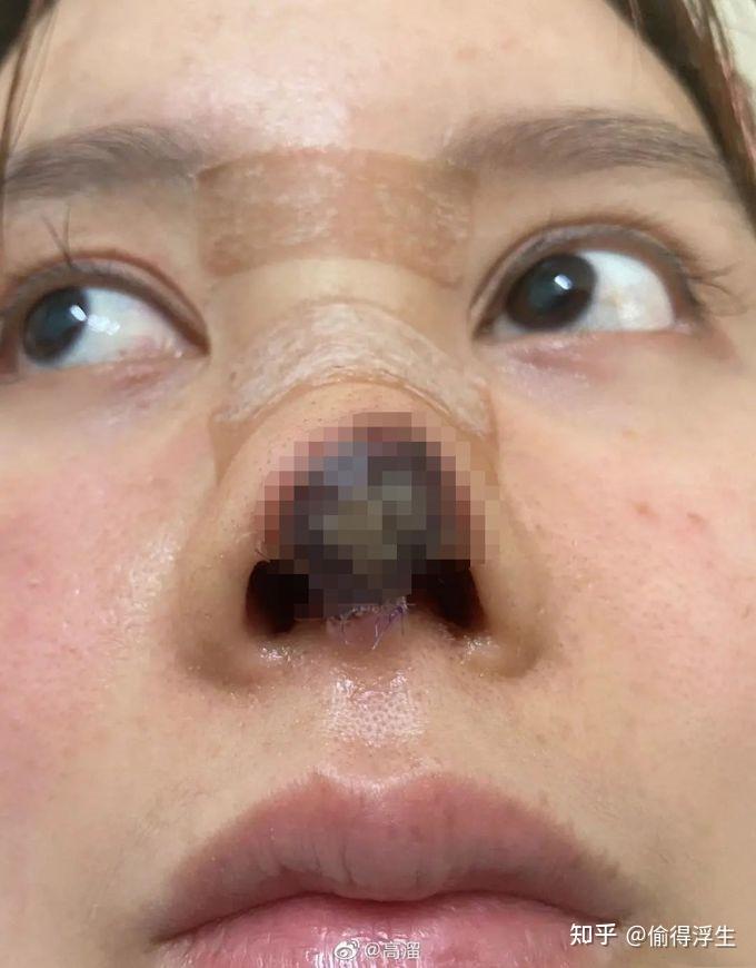 隆鼻后遗症图片图片
