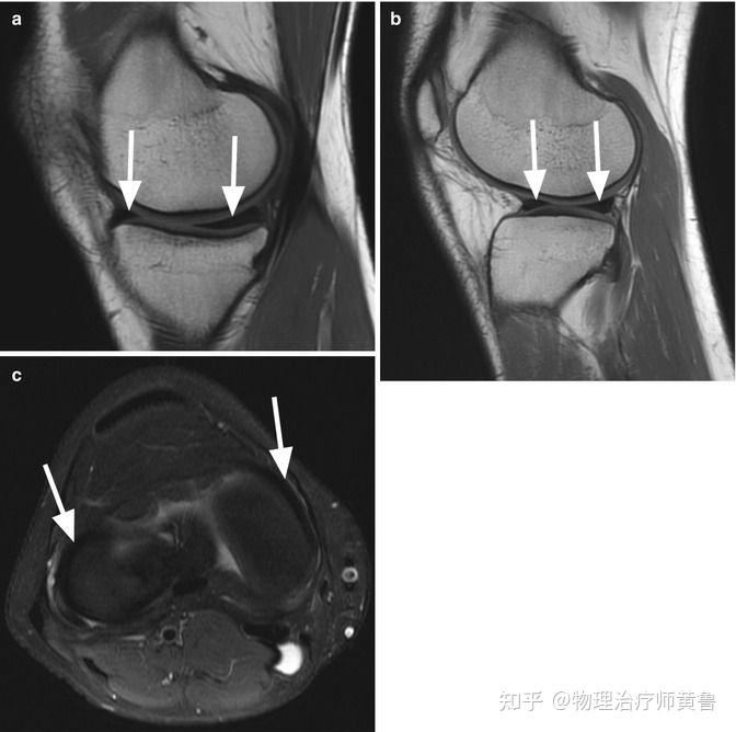膝内侧常见疼痛:半月板撕裂与皱襞综合征的鉴别诊断 - 知乎