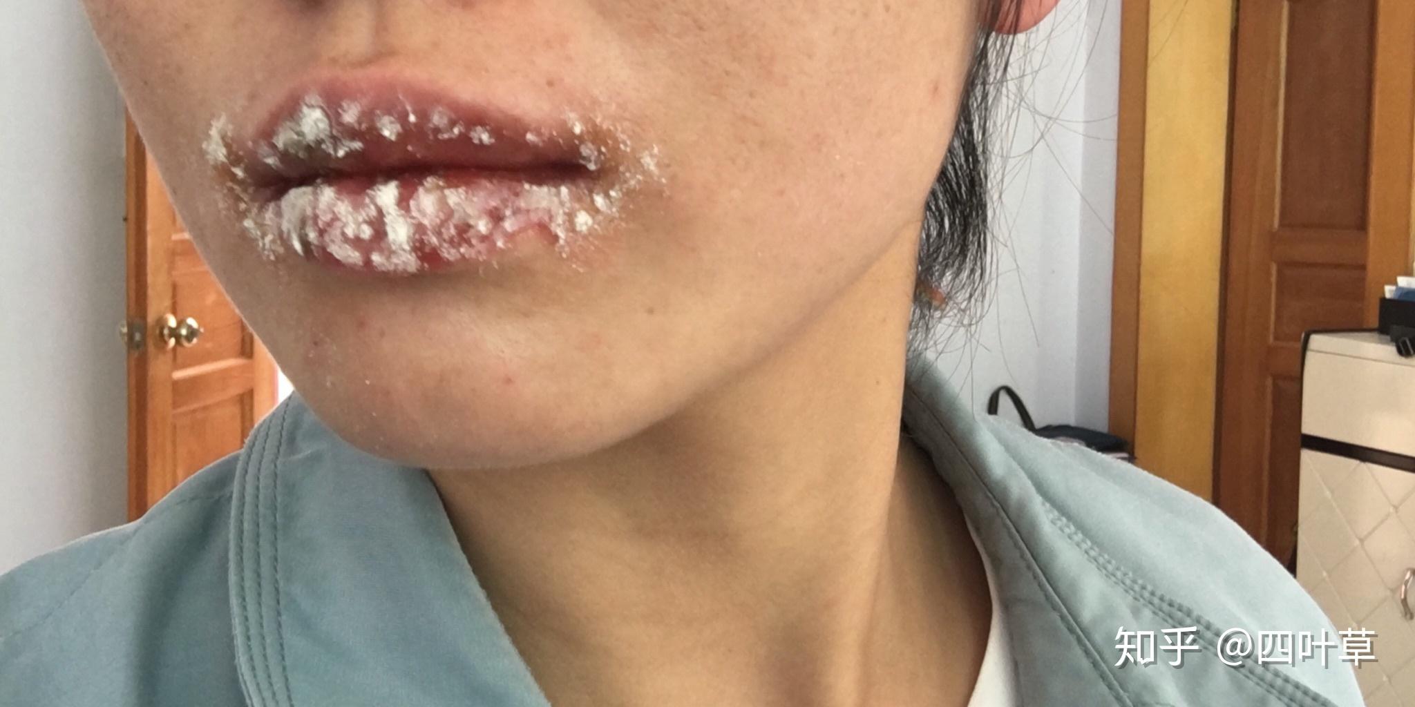 我的唇炎治疗分享