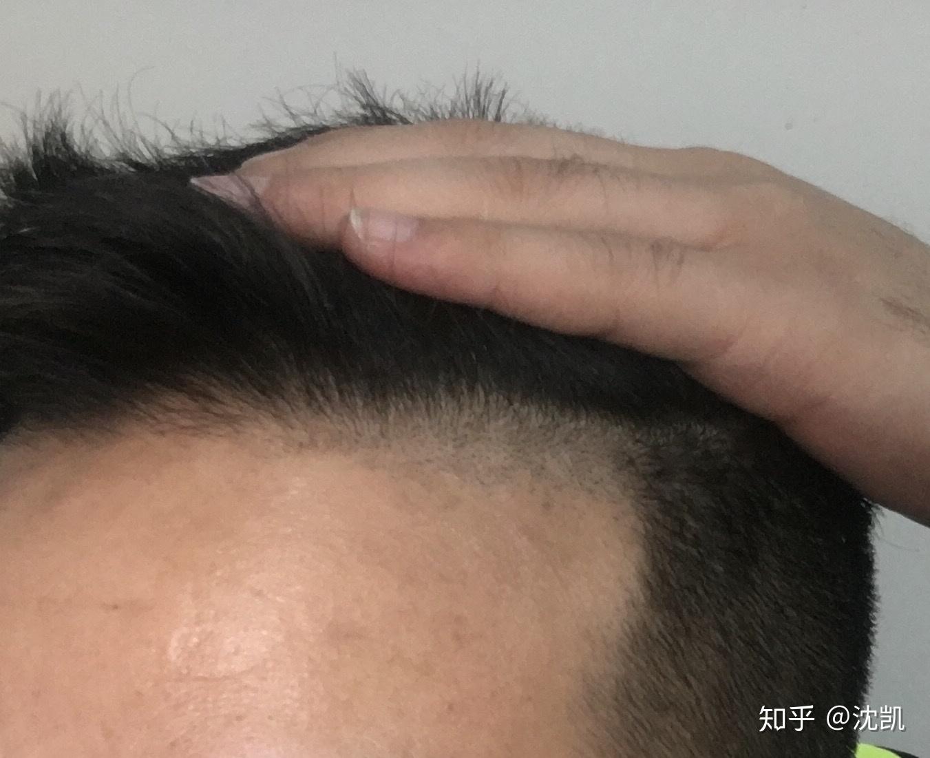 男生发际线后移m型什么发型比较合适