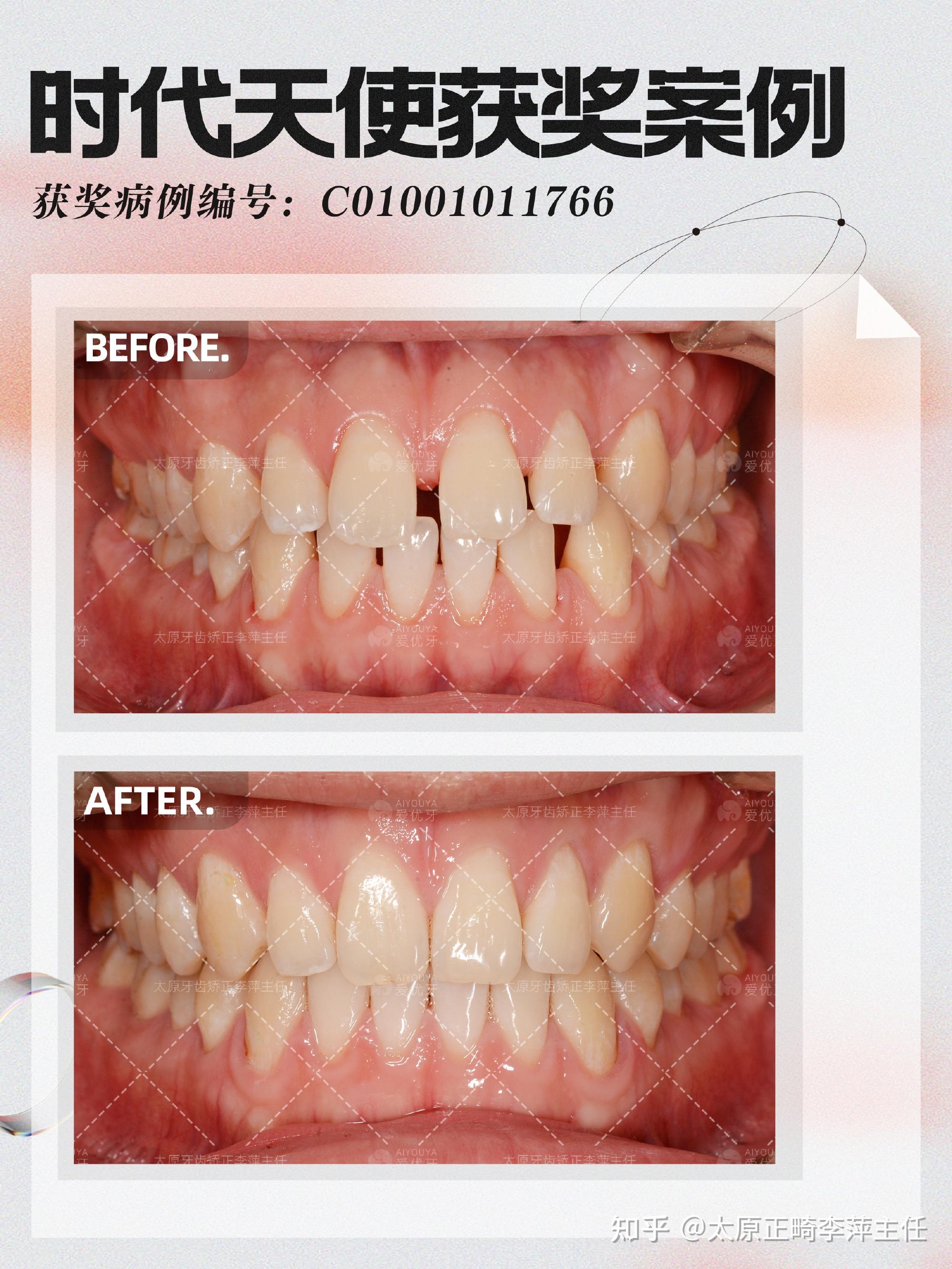 《正畸案例65-67:几例简单的牙齿排齐关闭缝隙》