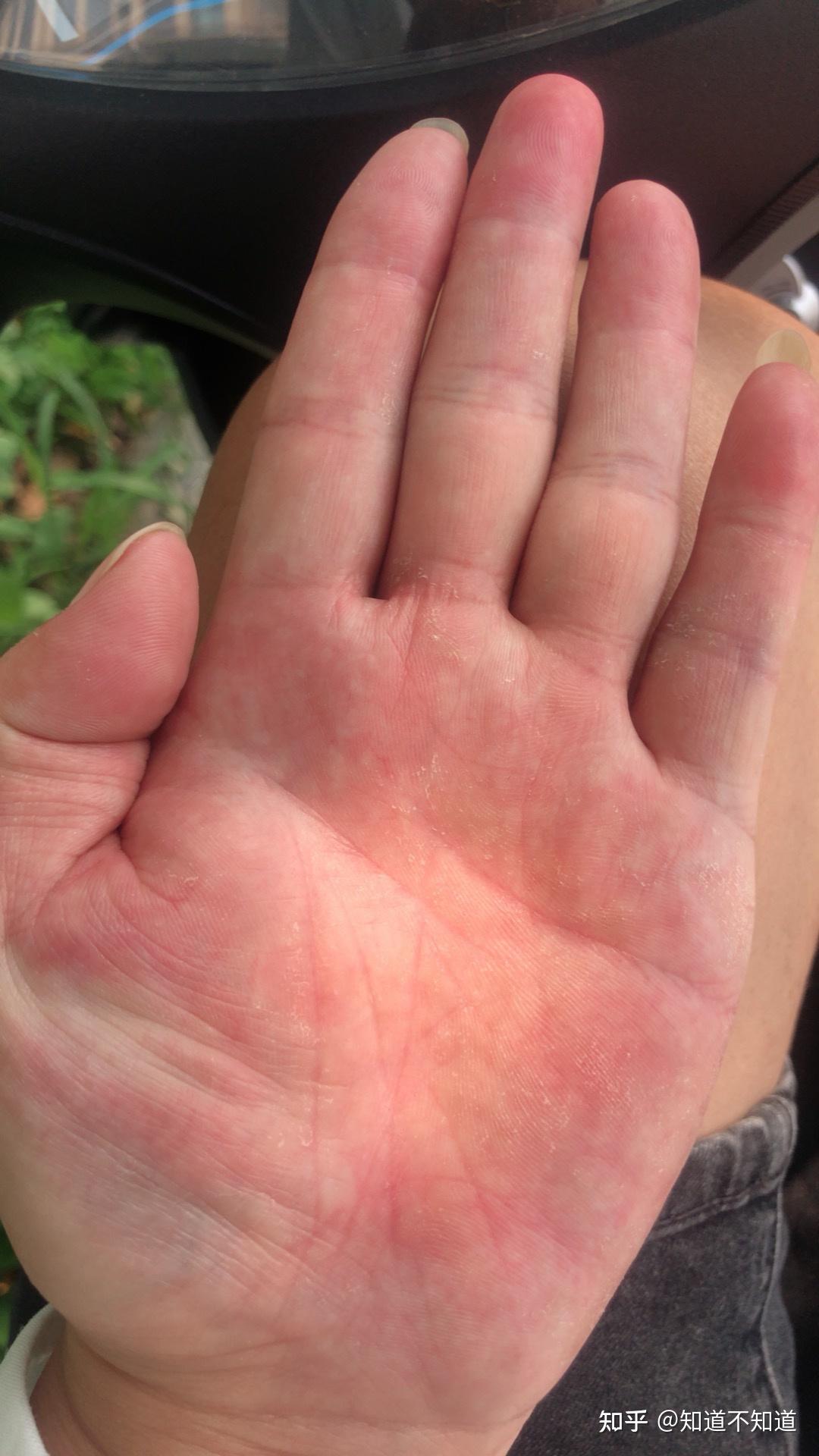 SKIN DISEASE TYPES: Vesicular Hand Dermatitis (Skin Disease type)