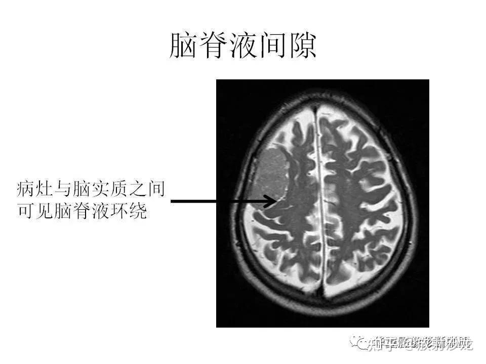 脑灰质与脑白质影像图图片