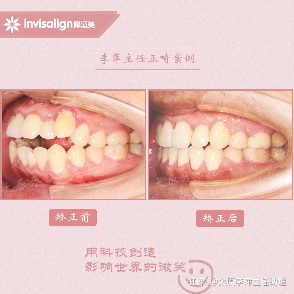 治疗结果:开合关闭,整体咬合正常,开合关闭,侧貌恢复