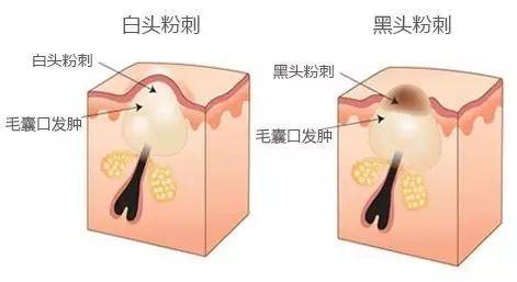 首先,又称黑头粉刺,是一种开放性粉刺,是堵塞毛孔的皮脂的表层直接