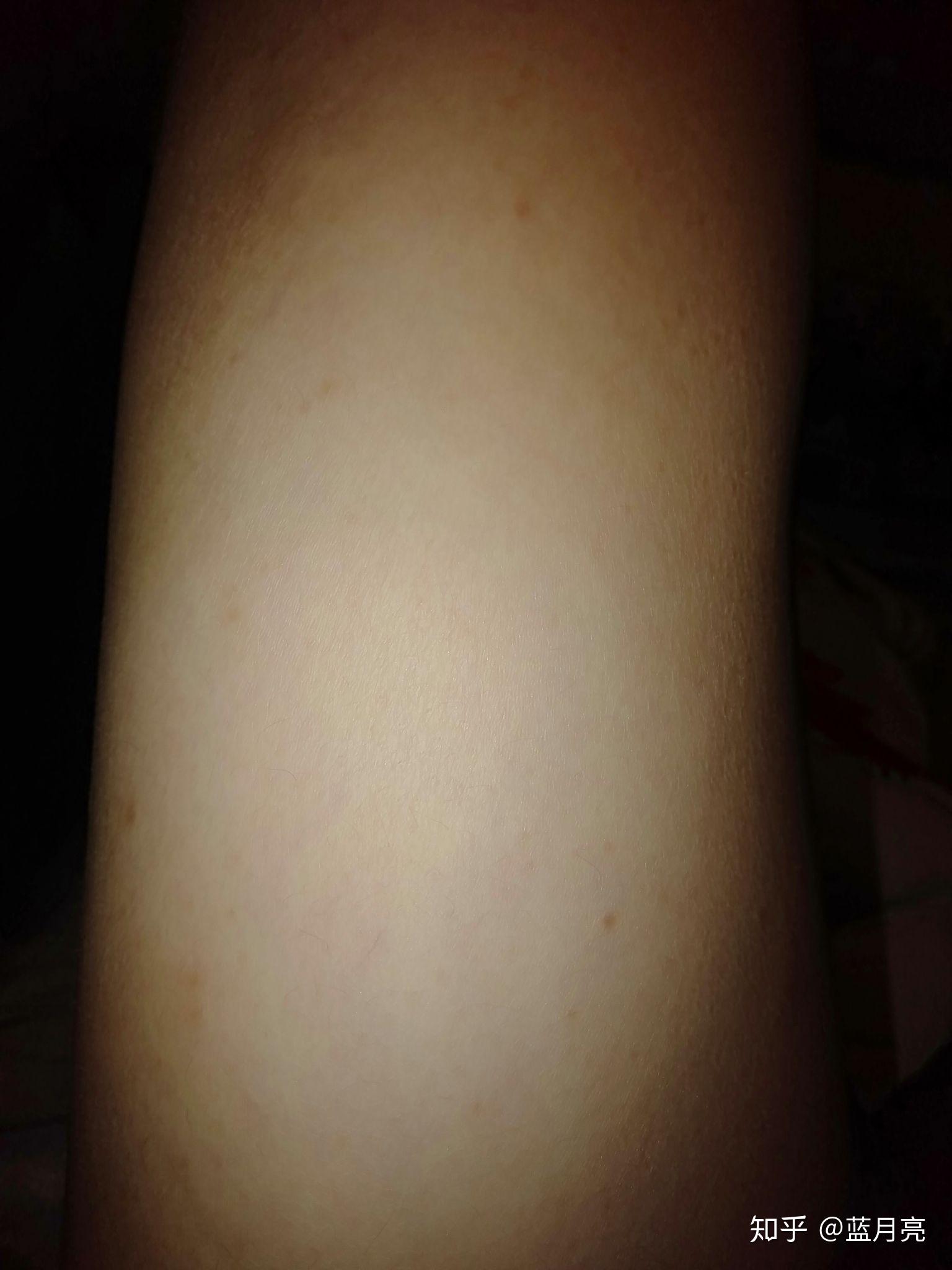 胳膊上长红色疙瘩很痒怎么回事 v2-65791aecc0996fa28eccba497e8d5002_r.jpg