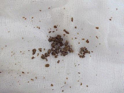 我的肾结石当时真是痛死人托人去香港买了这款德国碎石素