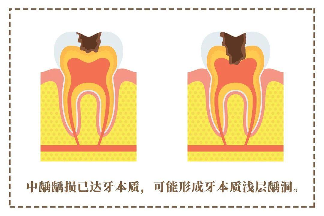 症狀)遇過冷,熱或酸,甜刺激時從中齲開始我們的牙齒將出現一些反應