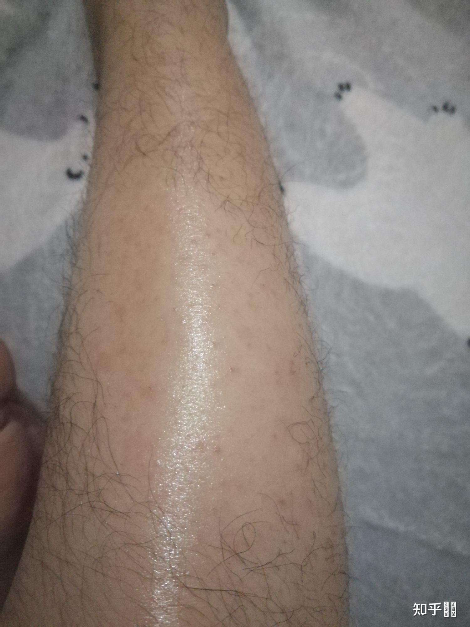 用镊子拔腿毛会有什么后遗症吗