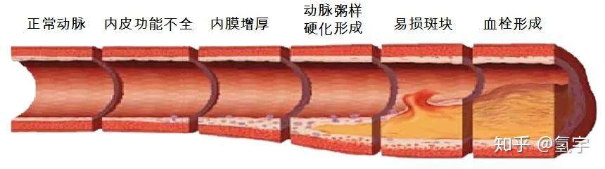 别把血栓不当回事，血栓死亡率远超肿瘤 - 知乎
