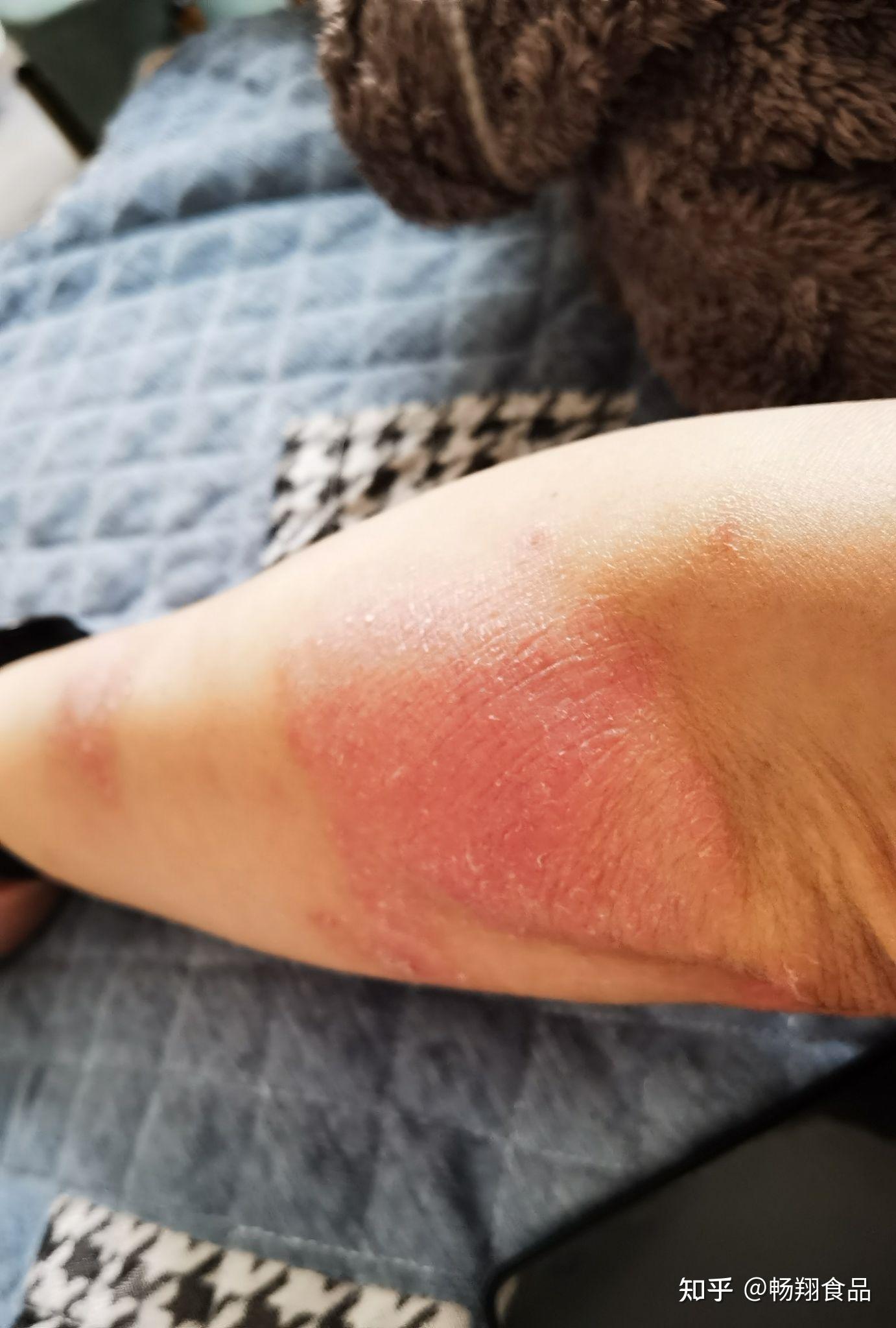 可善挺第四针,好像有效果了