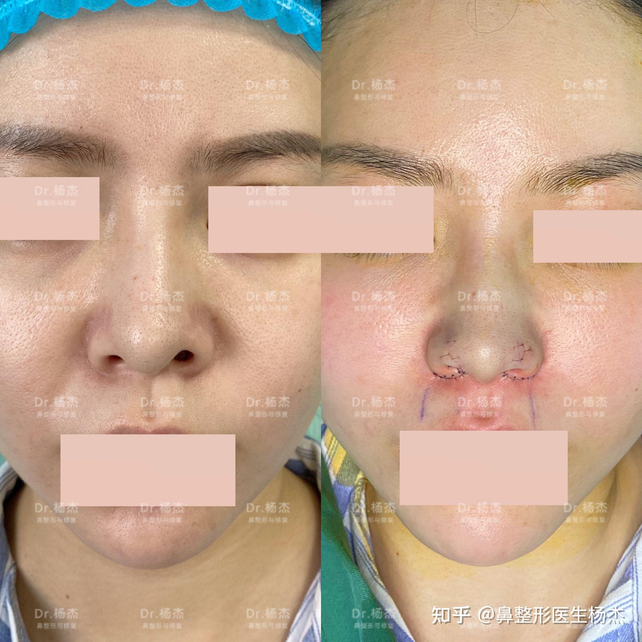 1人赞同了该文章 【 鼻翼缘退缩矫正  内切鼻翼鼻槛上提】 手术亮点