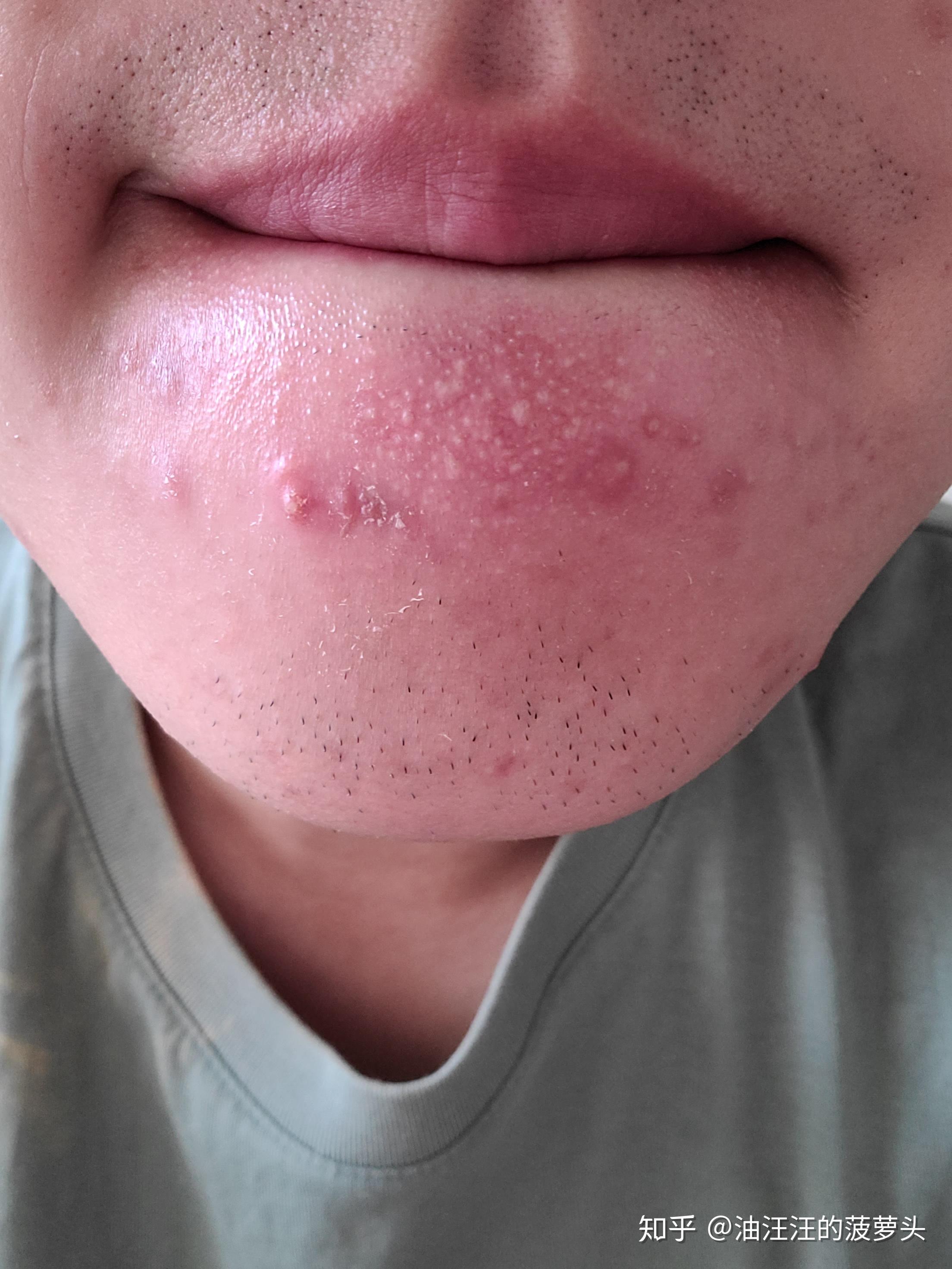 用了阿达帕林两个月了