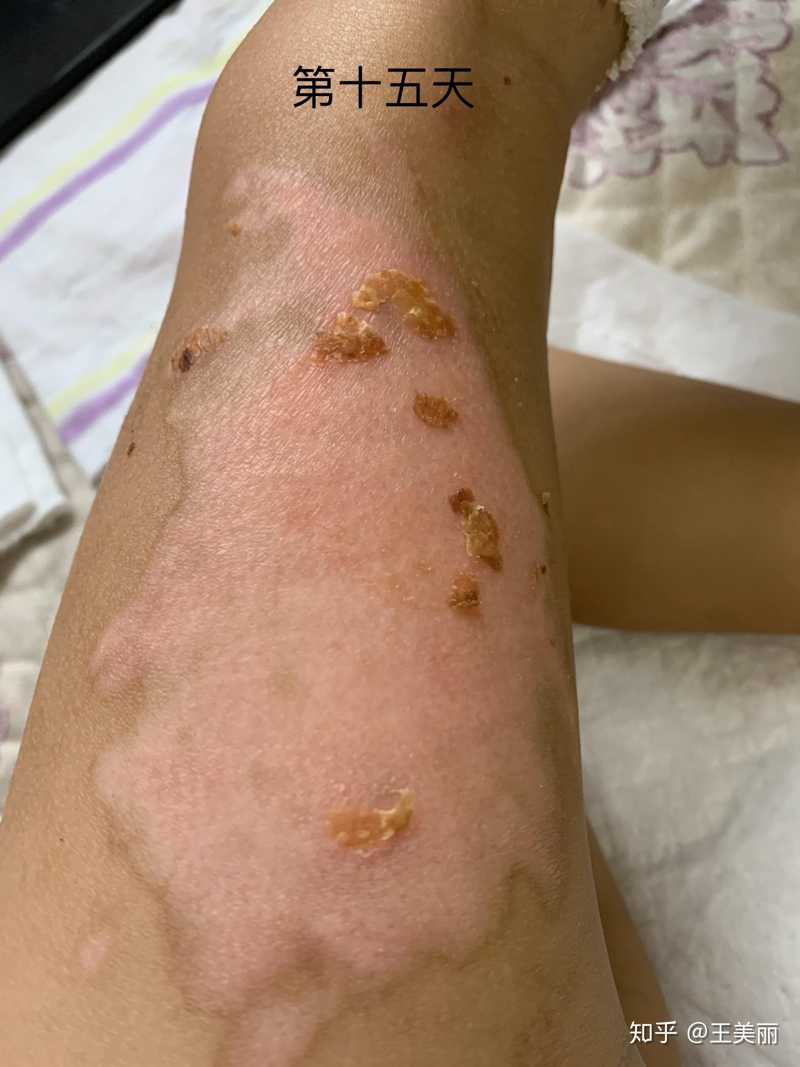 纪录两岁半宝宝开水烫伤恢复过程