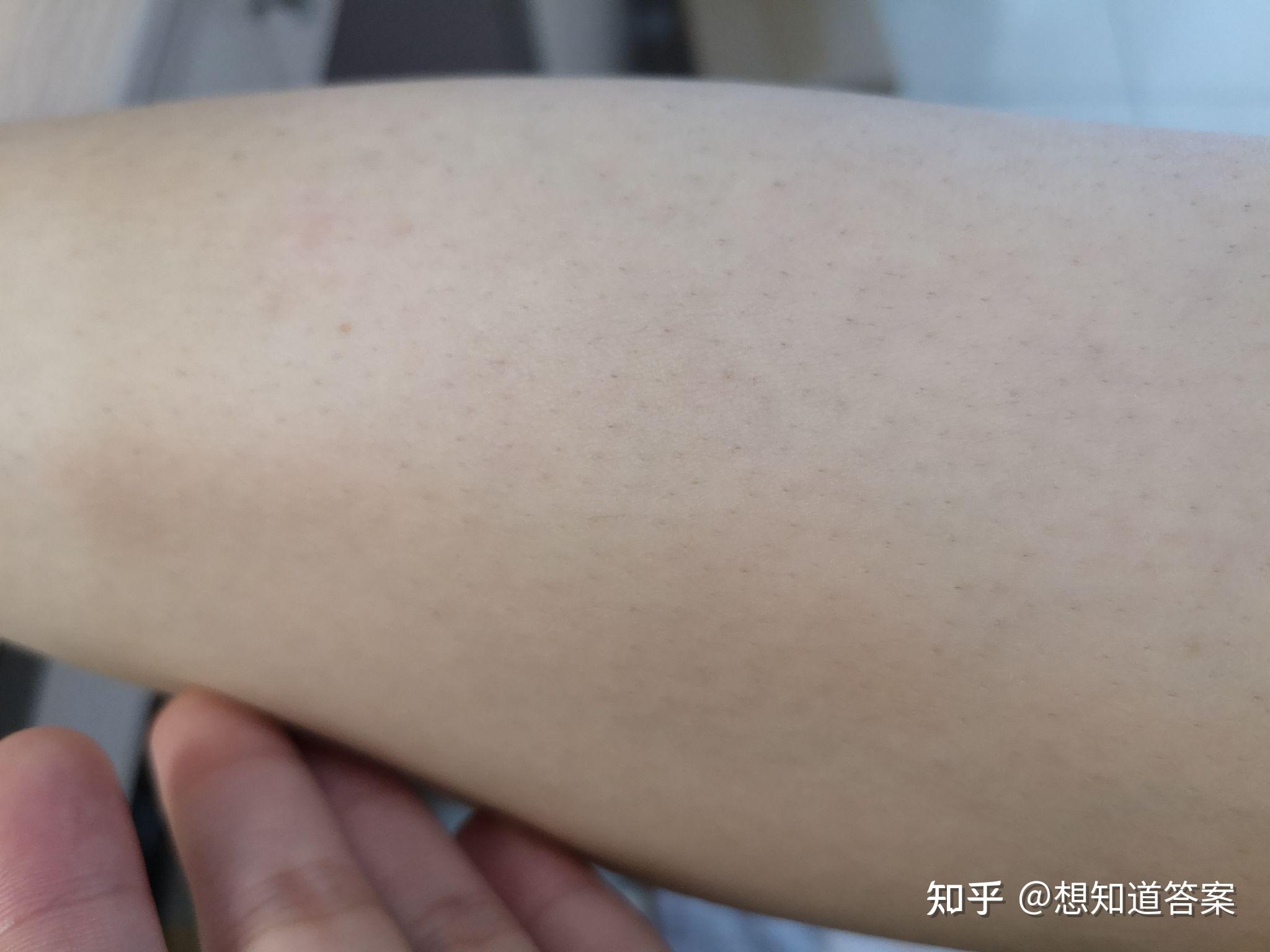 脱毛后腋下有鸡皮疙瘩痒(脱毛后腋下有鸡皮疙瘩痒怎么回事)