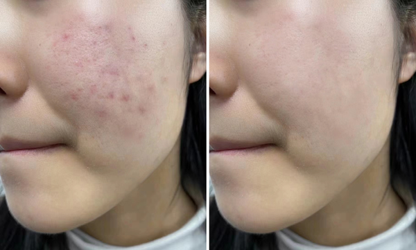 真人实测骆王宇刷酸脸上疯狂冒油痘痘黑头一大堆皮肤粗糙被轻松搞定是