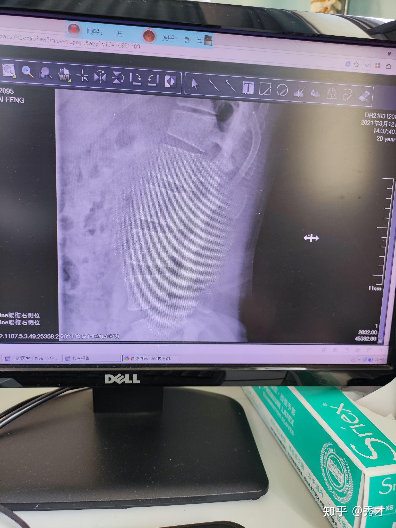 胸12椎体骨折图片