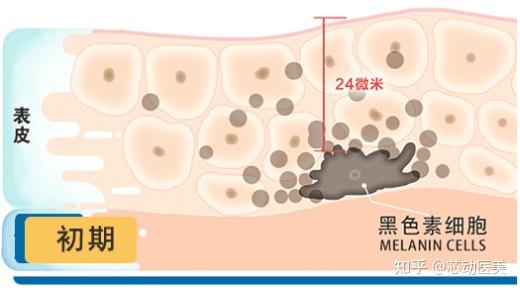 柠檬祛斑法有效吗 黄褐斑用什么祛除 知乎