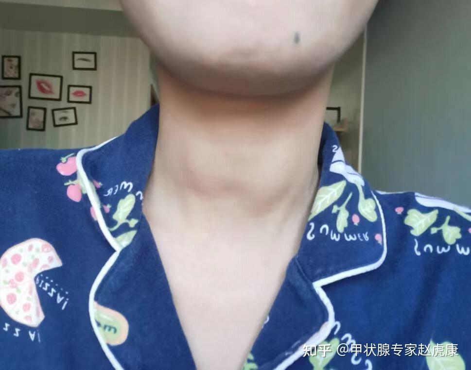 三个疗程干预4级甲状腺结节