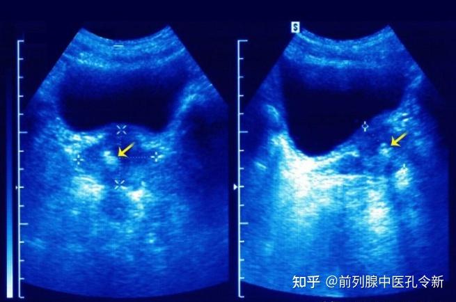 前列腺彩超图图片
