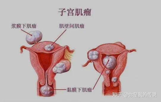 子宮肌瘤對懷孕有影響嗎