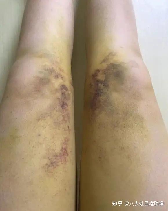 大腿抽脂丨大腿环吸抽脂后青紫严重是做的不好吗?要紧吗? - 知乎
