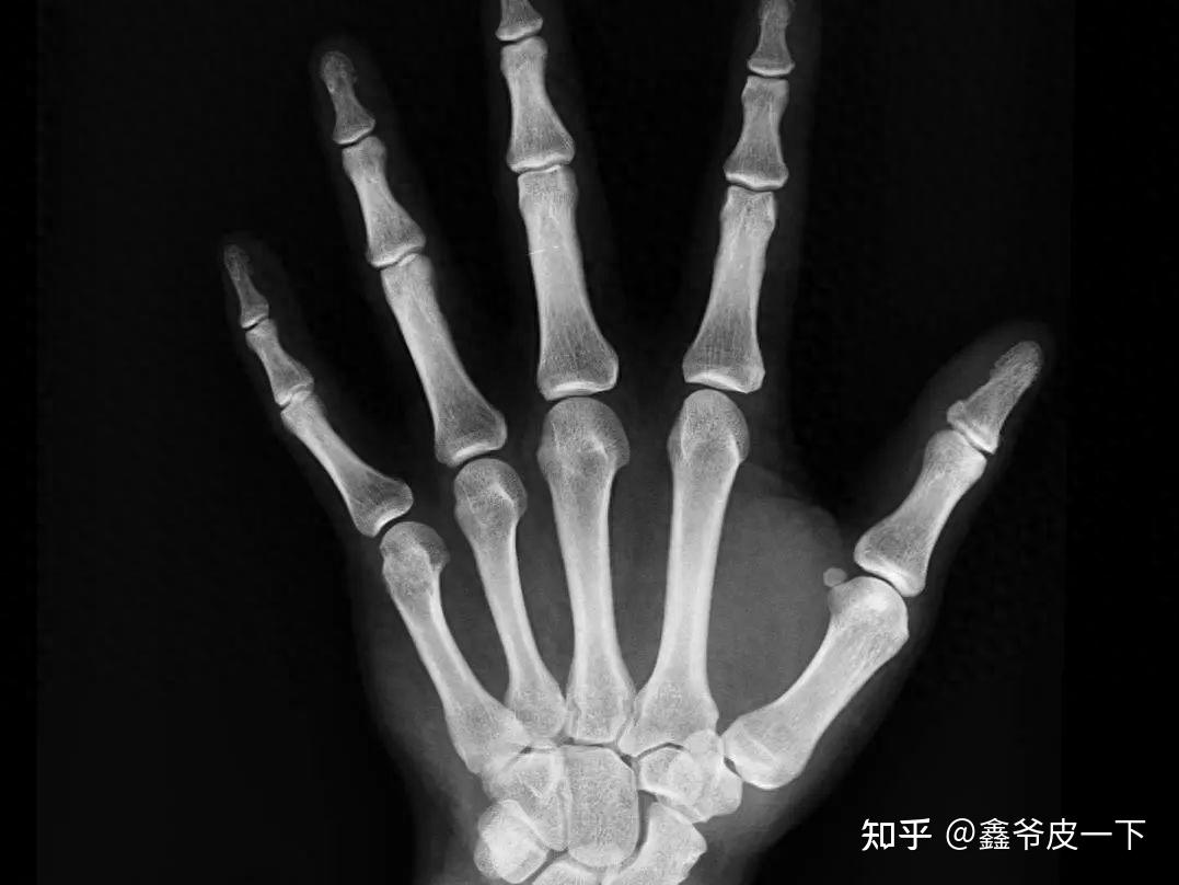 骨科拍片,X射线、CT、核磁共振到底有什么区别?(通俗版) - 知乎