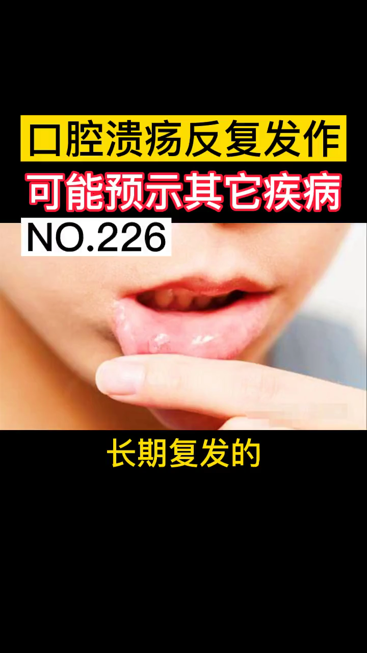 口腔溃疡是怎么引起的？ - 知乎