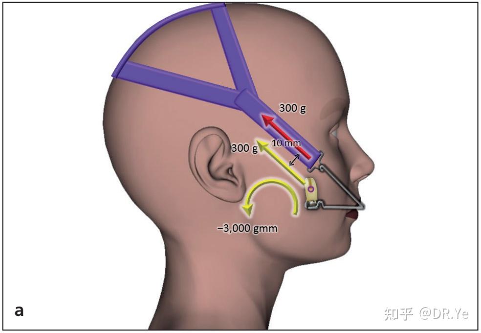 cervical headgear图片