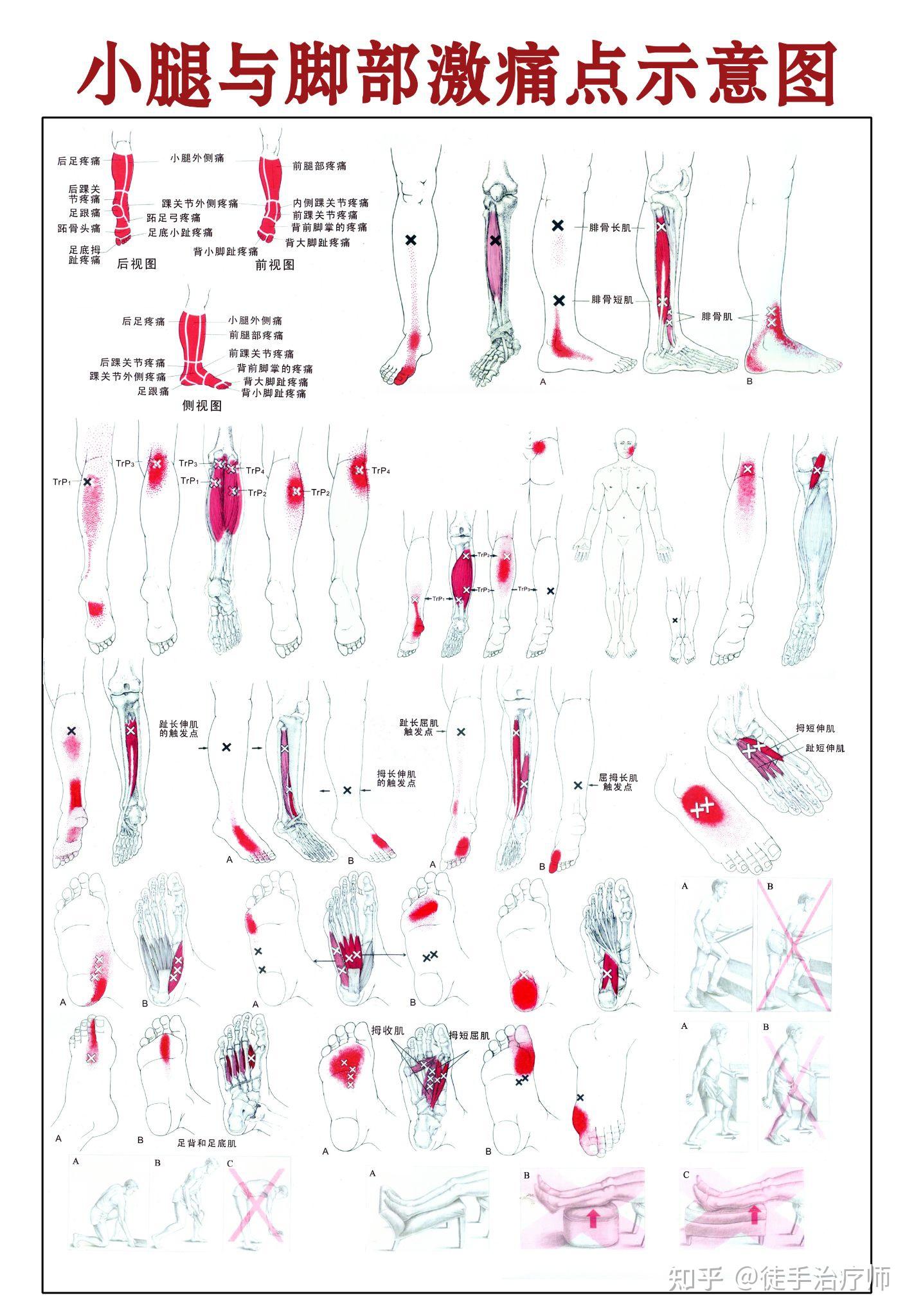 全身激痛点示意图