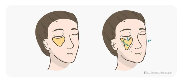 天生法令纹只能靠整容吗?那是因为你没看这篇