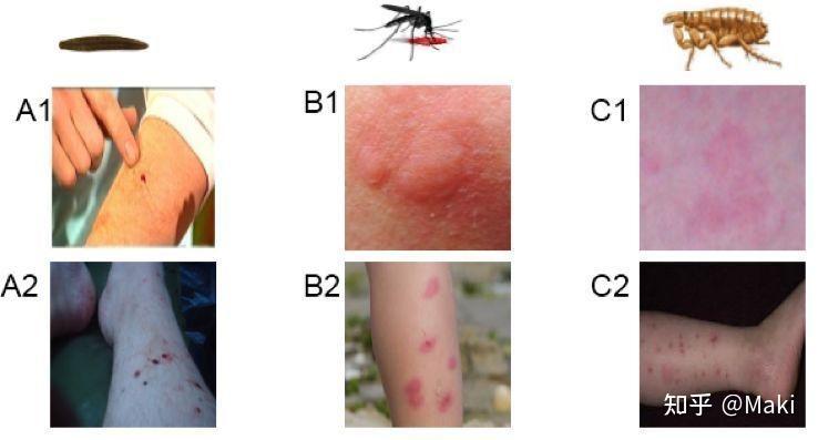 蚊子包和过敏的区别图图片