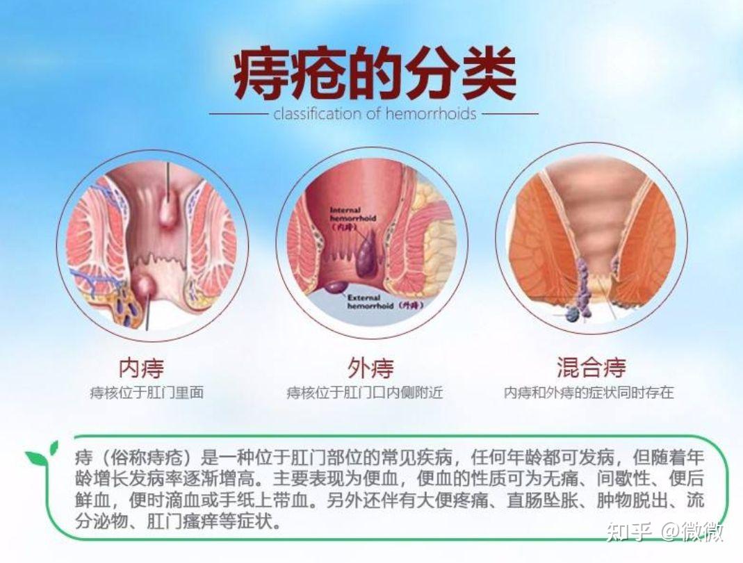 肛门外痔肉球怎么消除图片