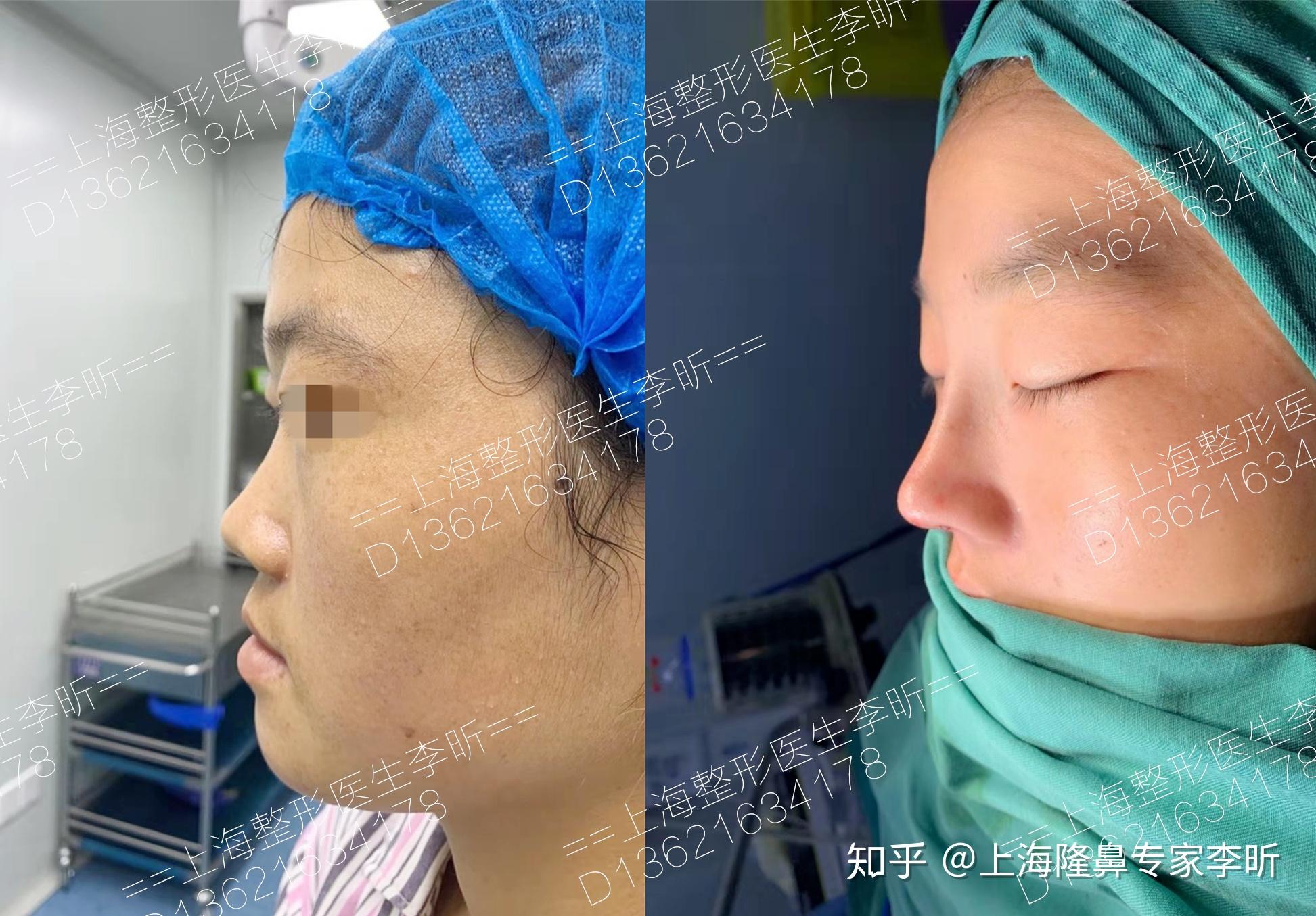 鼻尖形成3D法 の症例写真一覧｜新宿と池袋の美容整形は東京シンデレラ美容外科