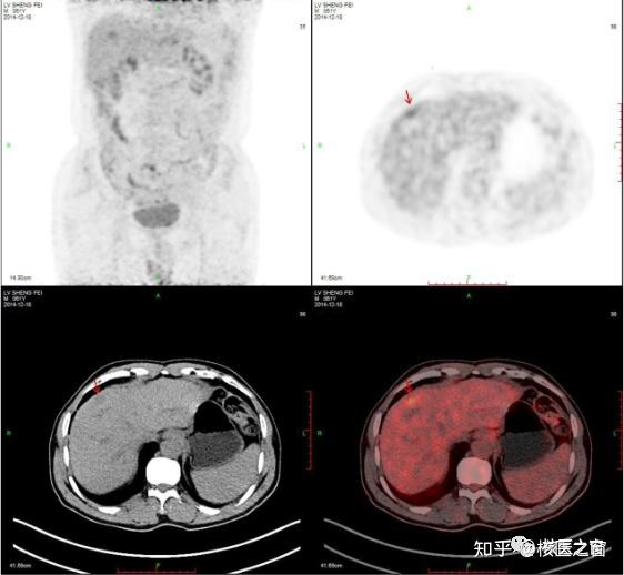 PET/CT在胃癌分期中的应用 - 知乎