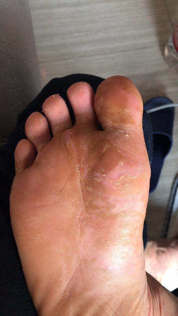 脚气害死人给大家分享一下吧