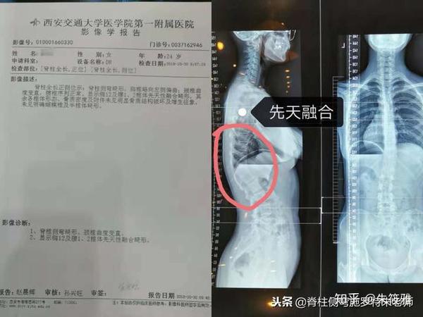 先天颈椎椎体融合图片 颈椎融合畸形危害 先天性椎体融合遗传吗