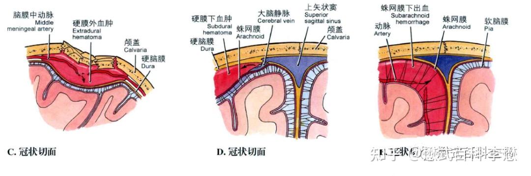 硬膜外血肿解剖图图片