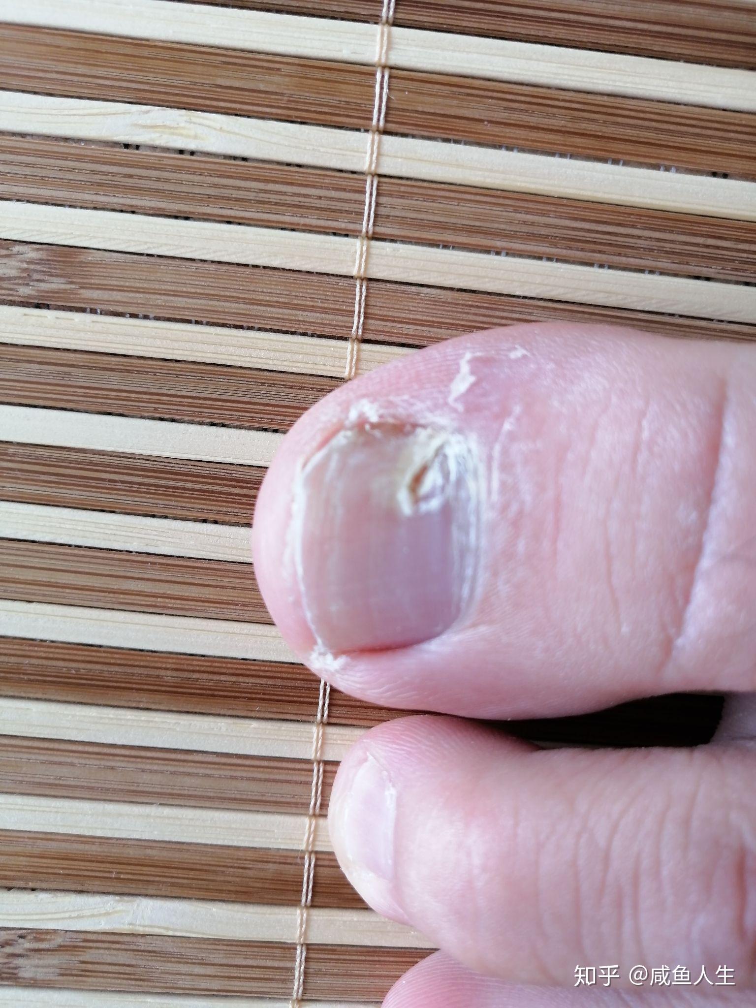 富有!脚大拇指甲沟炎怎么治"甘之如饴"-第1张图片-追风博客