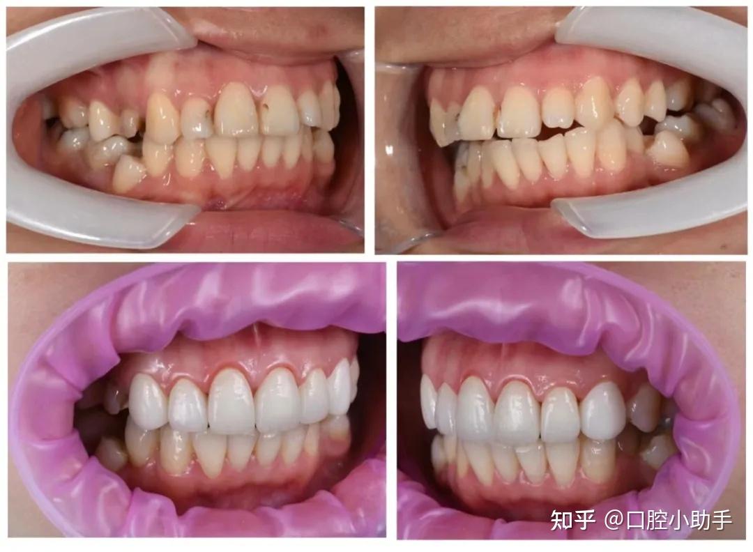 后牙残冠分体桩核修复（原创）-刘玉峰的博客-KQ88口腔博客