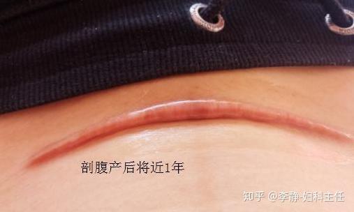 同样是一刀，侧切和剖腹产是完全不一样的概念 - 知乎