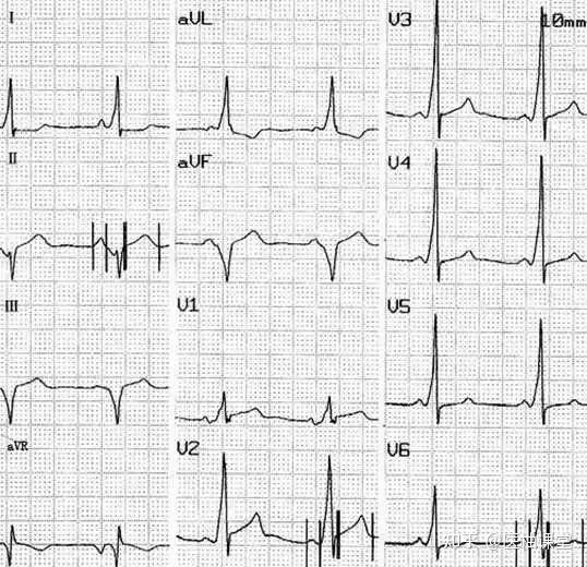 心室预激心电图分型图片