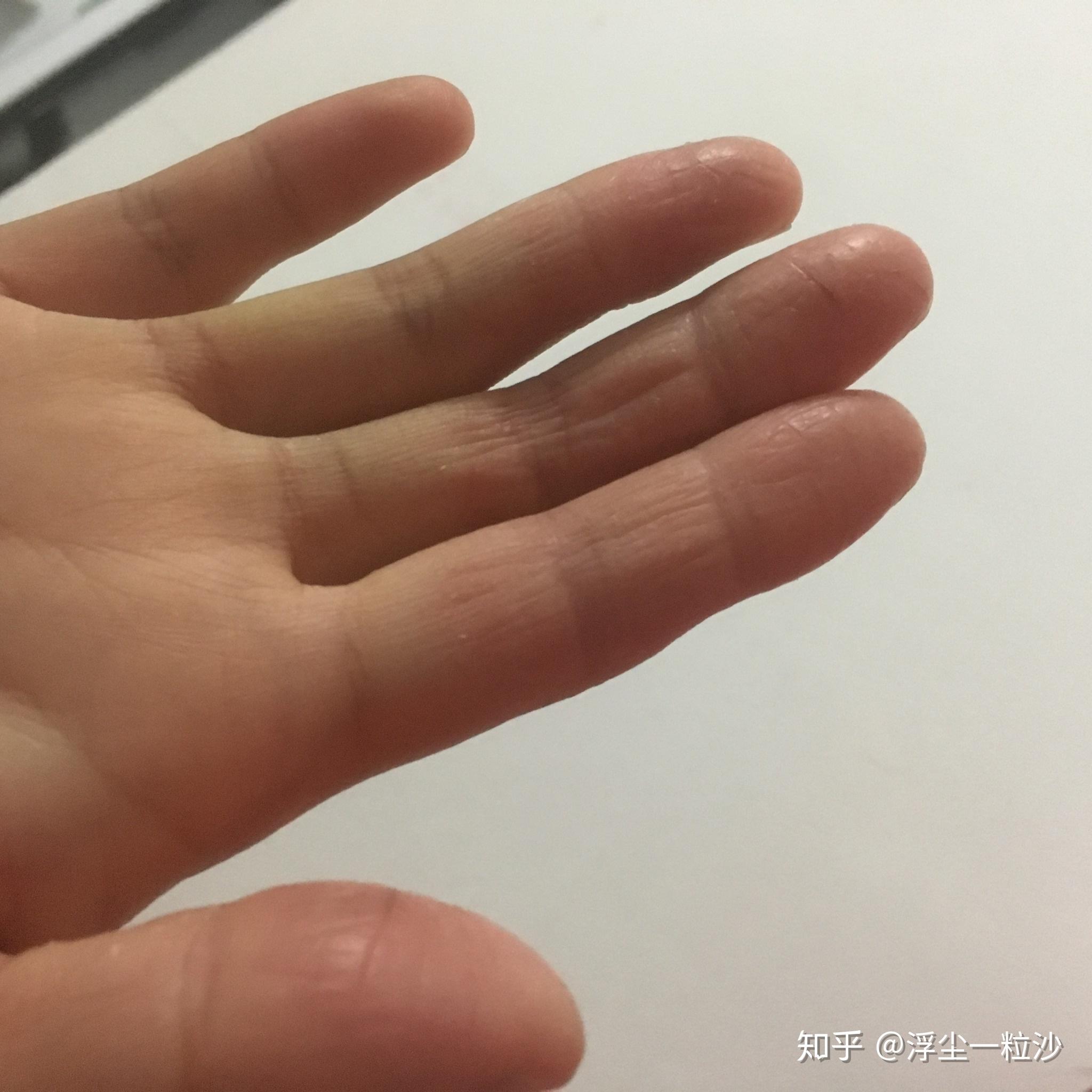 手指起皮,单个手指,干裂,不痒,化验过,不是真菌
